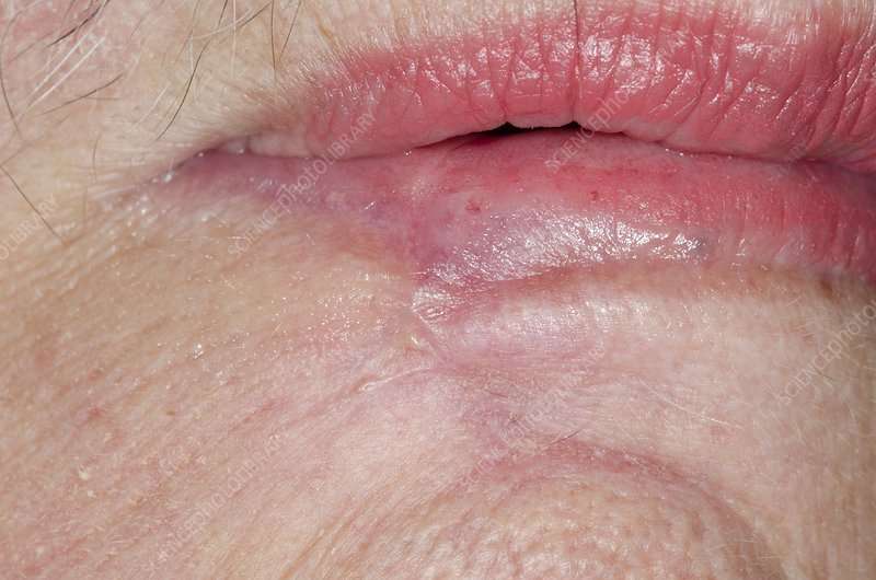 What Does Skin Cancer On Lip Look Like