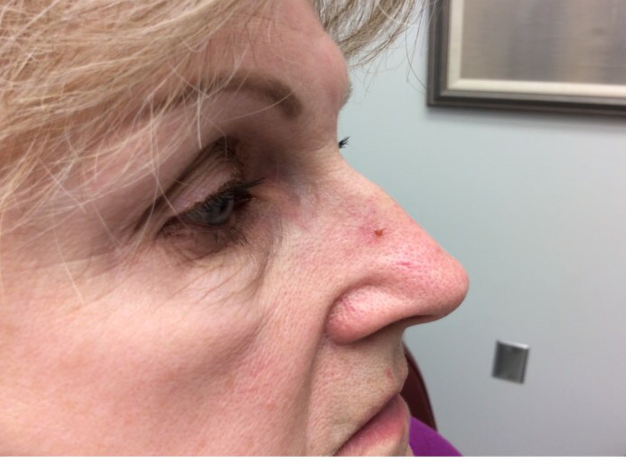What Does Skin Cancer On Nose Look Like