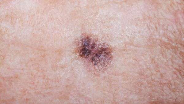 What Does Skin Cancer Really Look Like?