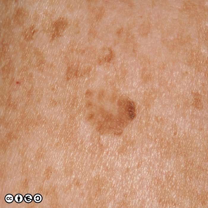 What Does The Early Stage Of Melanoma Look Like : Skin ...