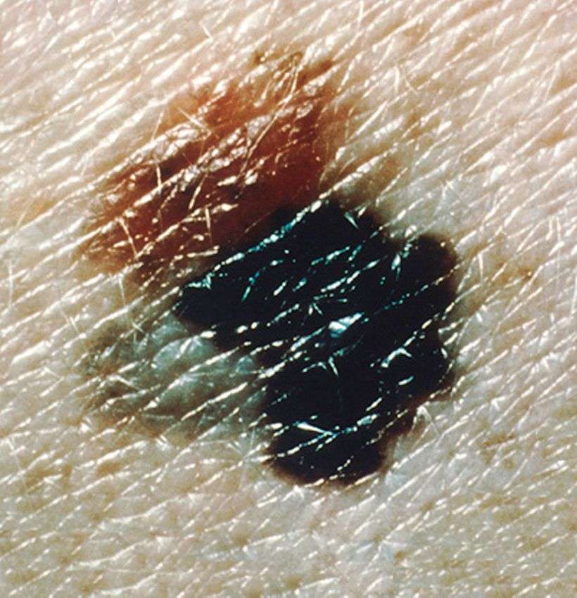 What Everyone Should Know About Skin Cancer