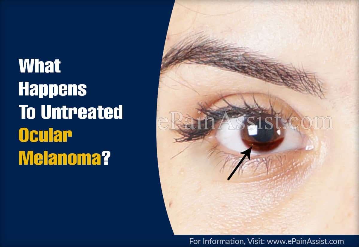 What Happens To Untreated Ocular Melanoma &  When To Go To ...