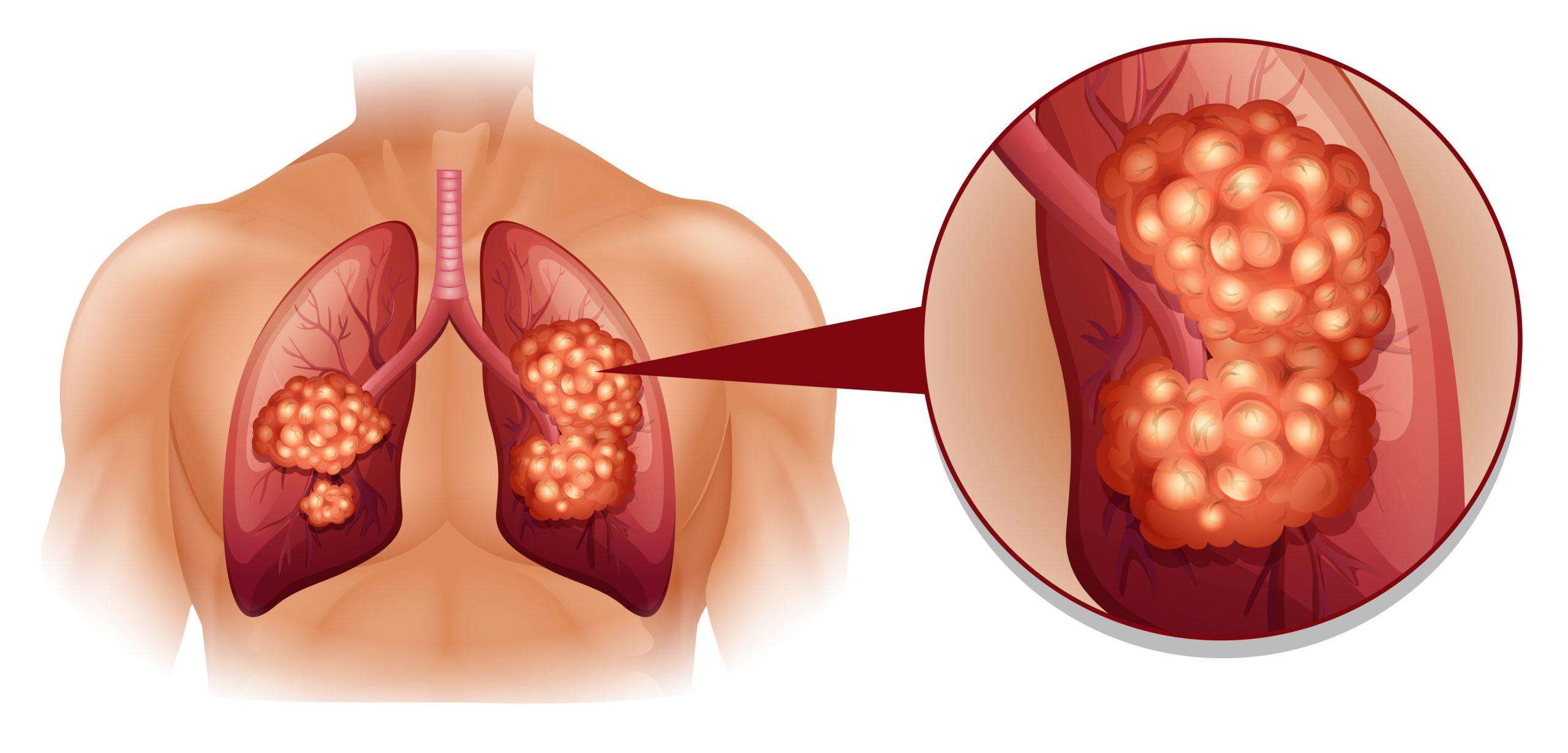 What Happens to Your Body When You Have Lung Cancer ...