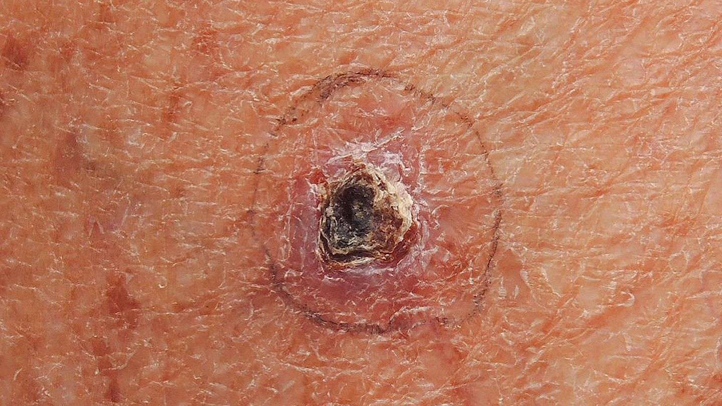 What Is Basal Cell Carcinoma Skin Cancer?