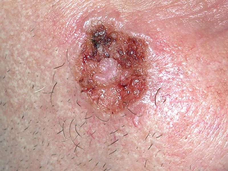 What is Basal Cell Carcinoma