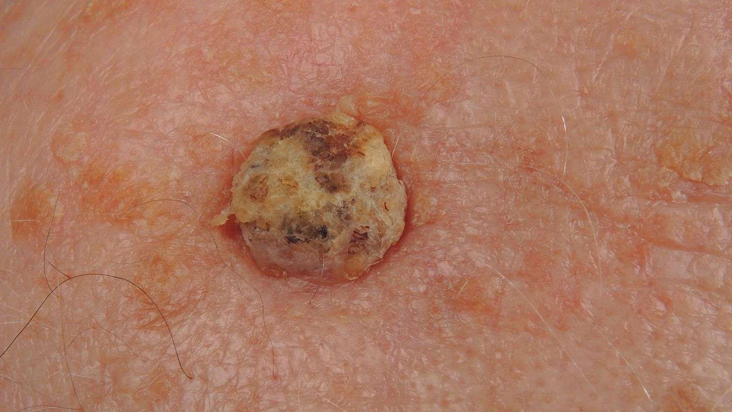 What Is Cutaneous Squamous Cell Carcinoma? Symptoms ...