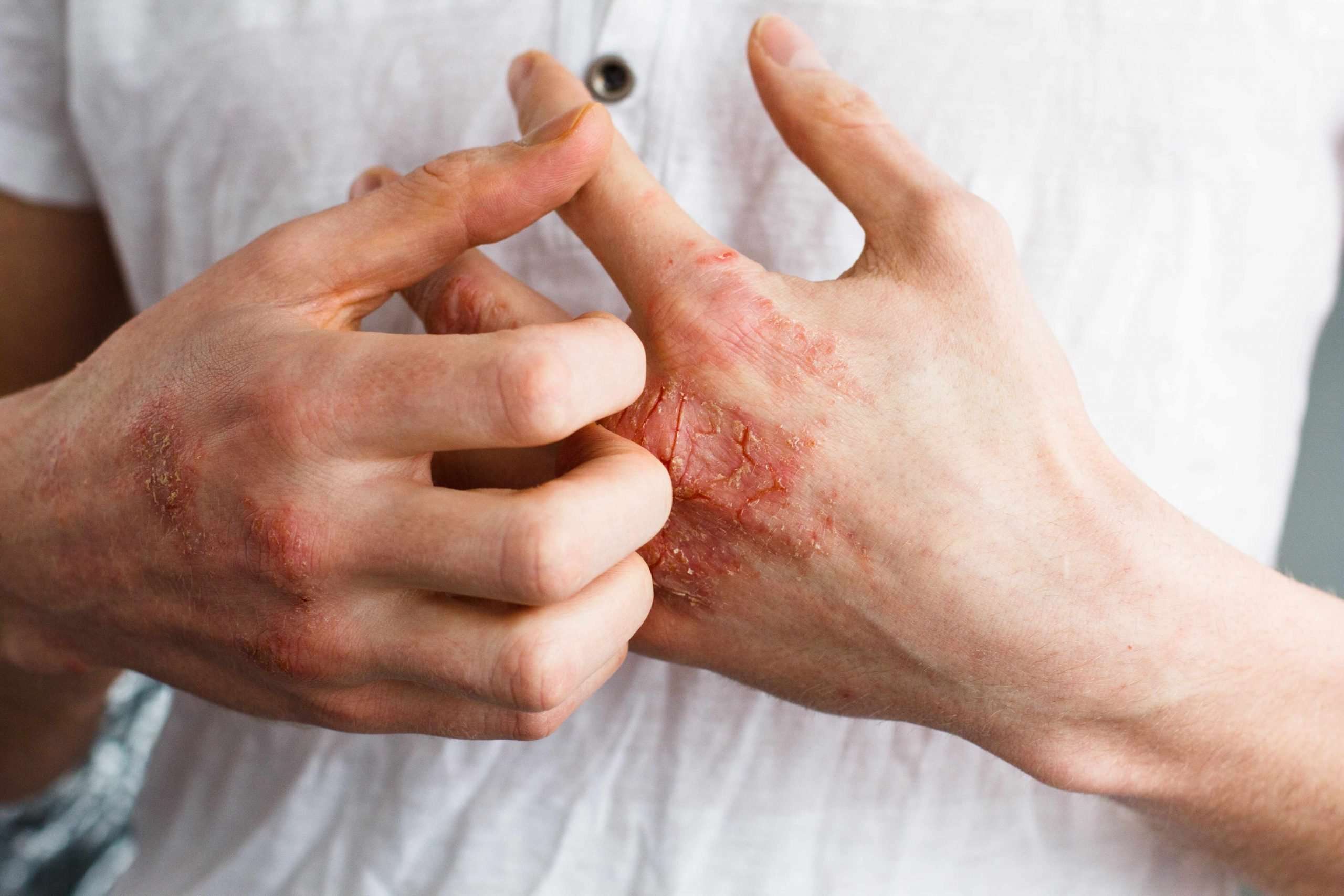 What is Eczema and How Can it Affect You