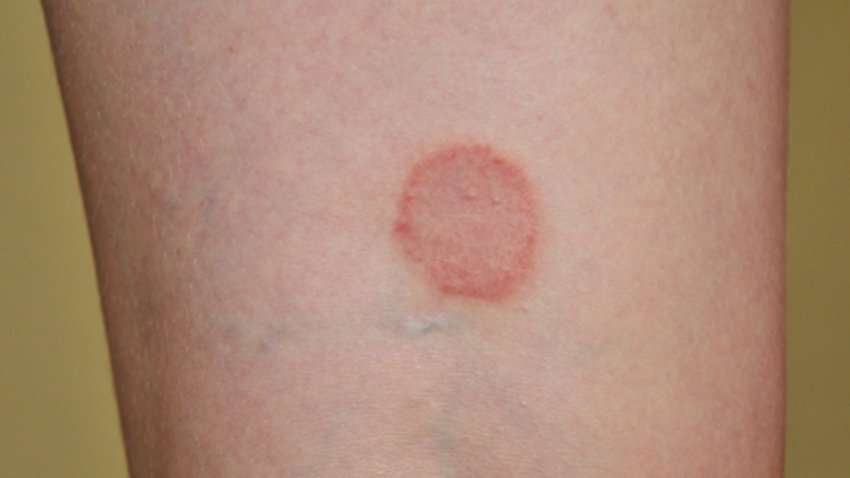 What is Granuloma Annulare?