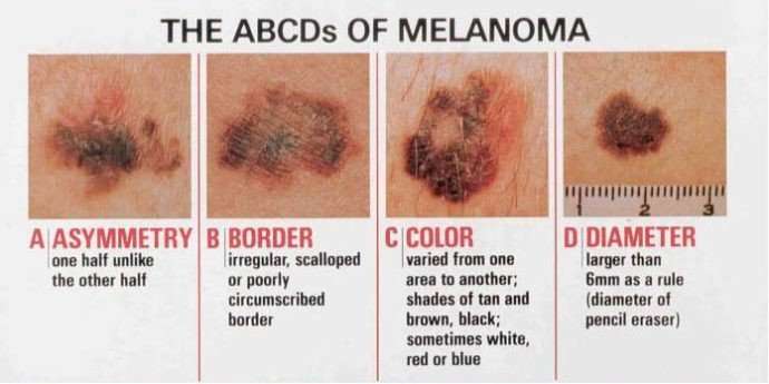 What is Melanoma? Causes, Melanoma Symptoms and Risk ...