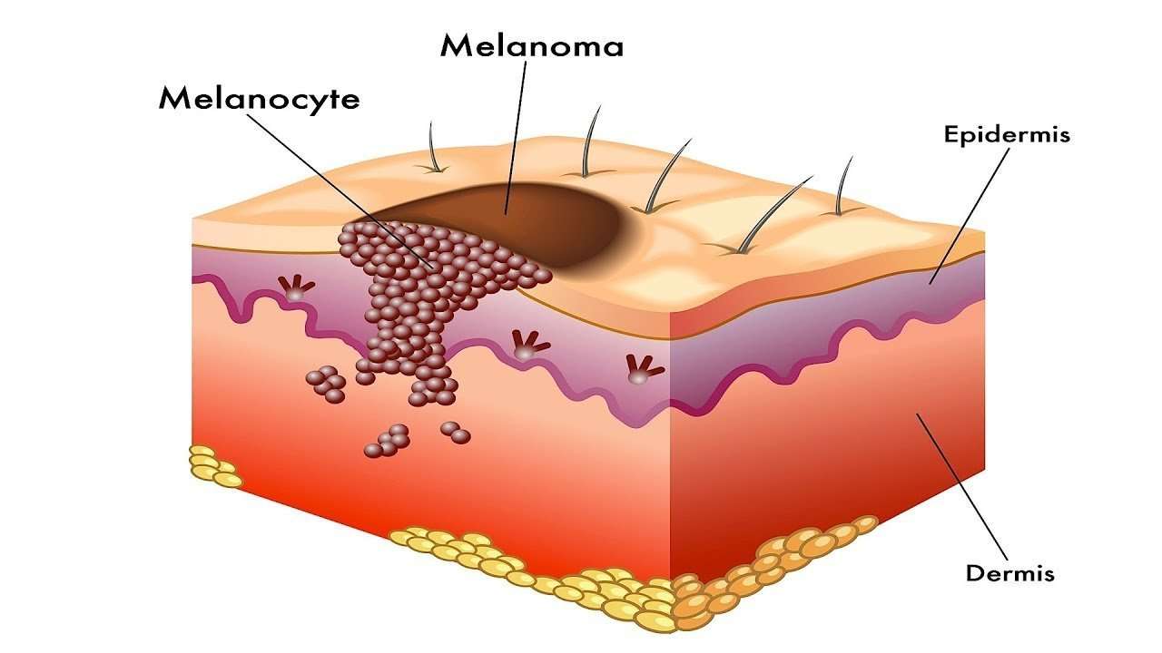 What Is Melanoma?