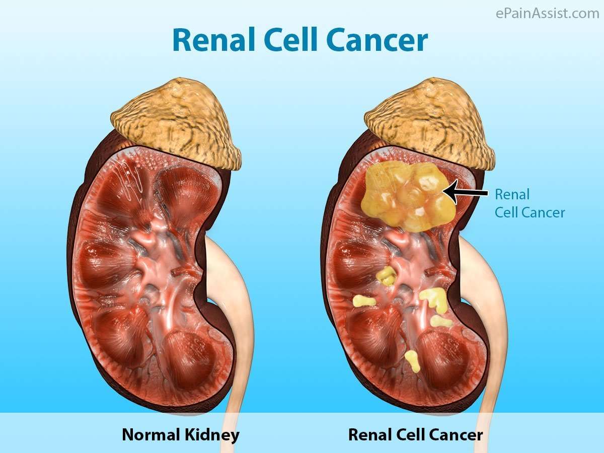 WHAT IS RENAL CELL CARCINOMA?