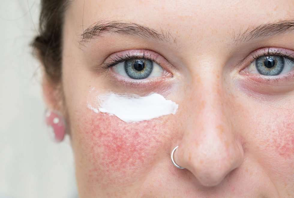 What is Rosacea, and how you can treat it!
