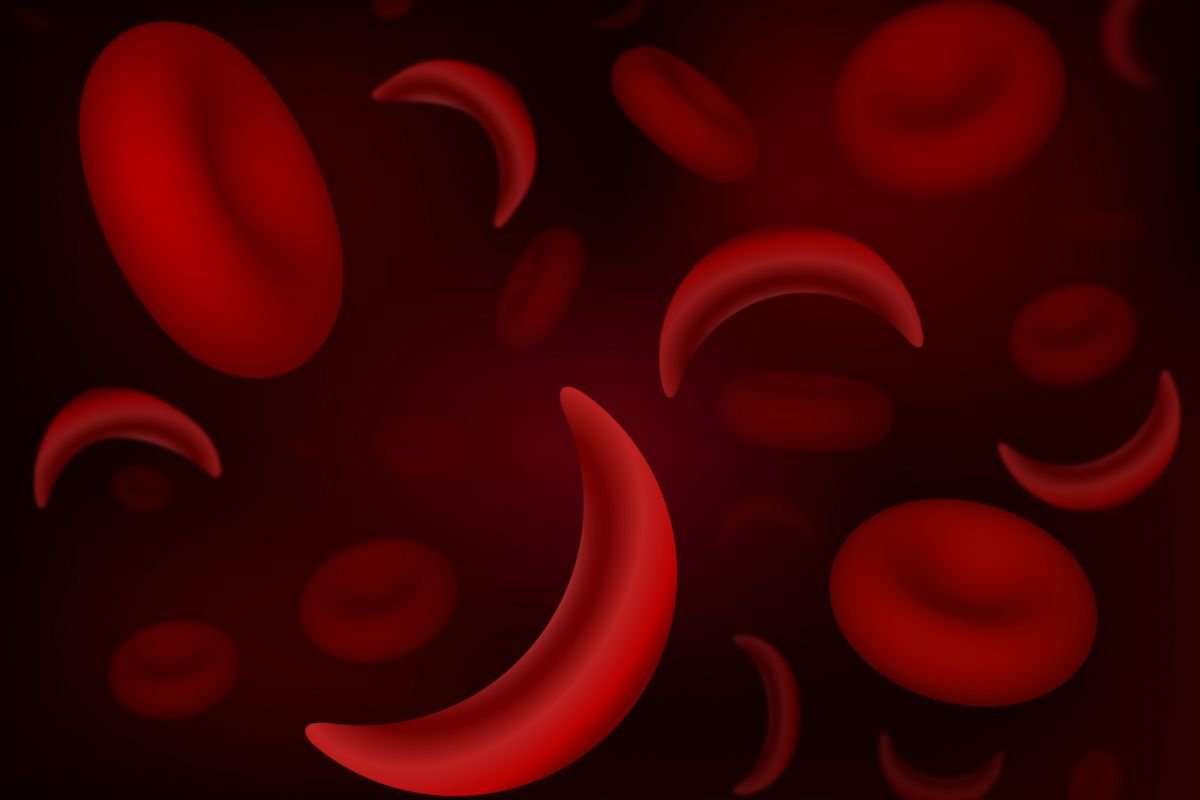 What Is Sickle Cell Disease?