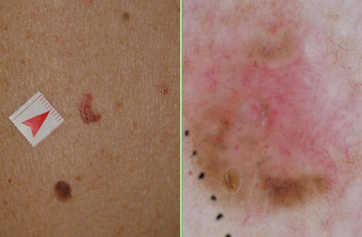 What is skin cancer?
