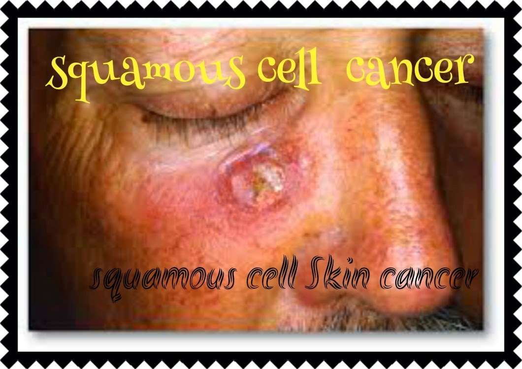 what is squamous cell cancer ( squamous cell Skin cancer ...