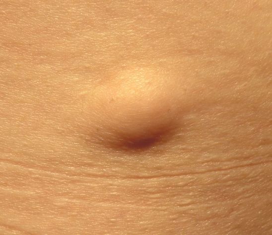 What is the Difference Between Cyst and Lipoma