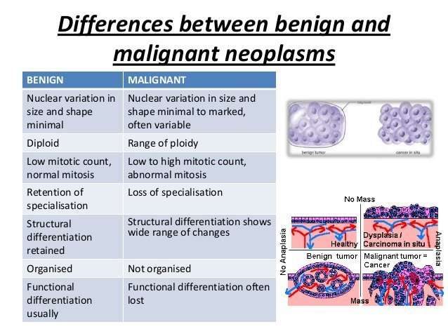 What is the Difference between malignant tumors and benign ...