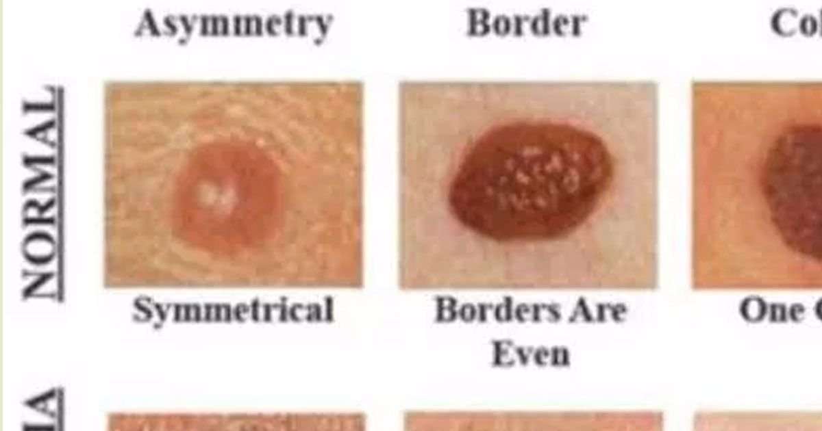 What Is The Most Deadly Skin Cancer