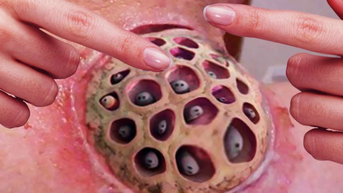 What is Trypophobia? What Causes Fear of Holes?