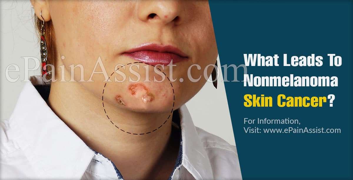 What Leads To Nonmelanoma Skin Cancer &  Can It Be Cured?