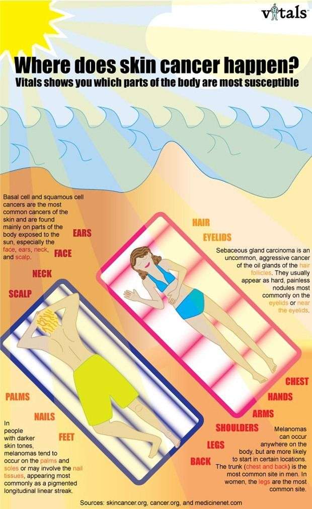 What parts of your body are most susceptible to skin cancer?