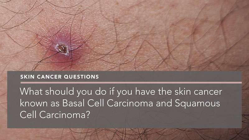 What should you do if you have Basal Cell Carcinoma and ...