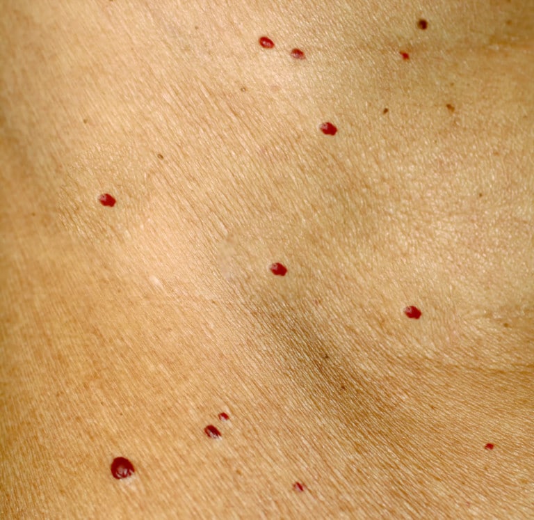 What Those Tiny Red Dots on Your Skin Might Mean » Scary Symptoms