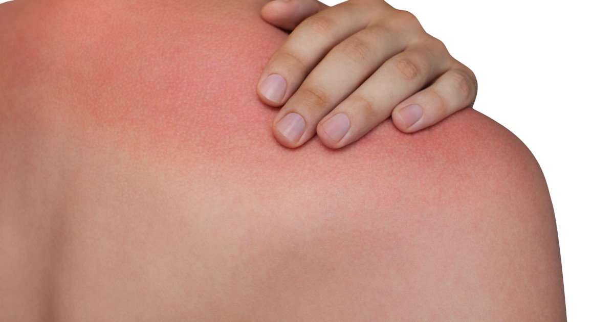 What to do if you get sunburnt