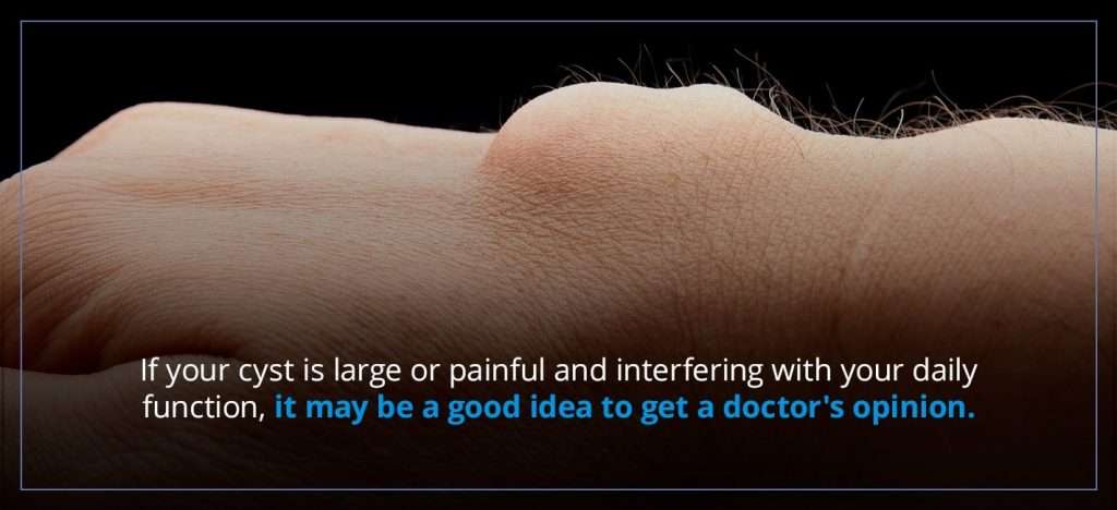 What to Do When a Ganglion Cyst Ruptures