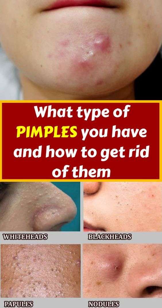 What type of pimples you have and how to get rid of them ...