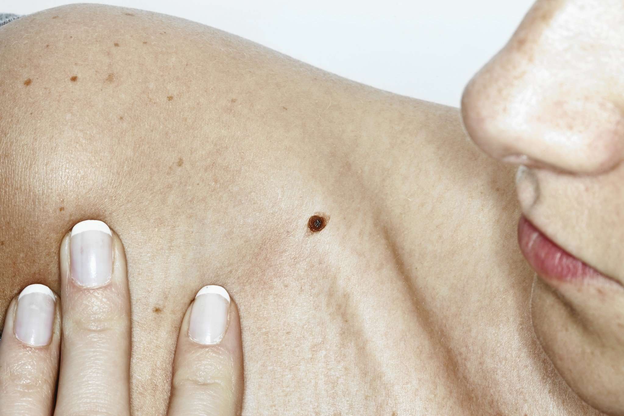 What you need to know about skin cancer, and how to ...