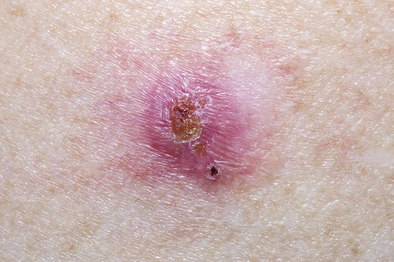What You Should Know About Basal Cell Carcinoma ...