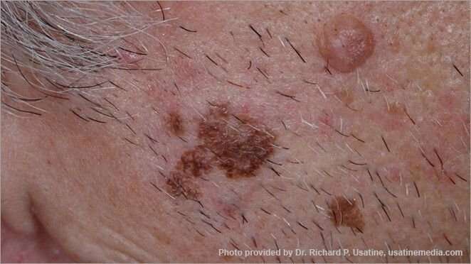 Whats Skin Cancer Look Like