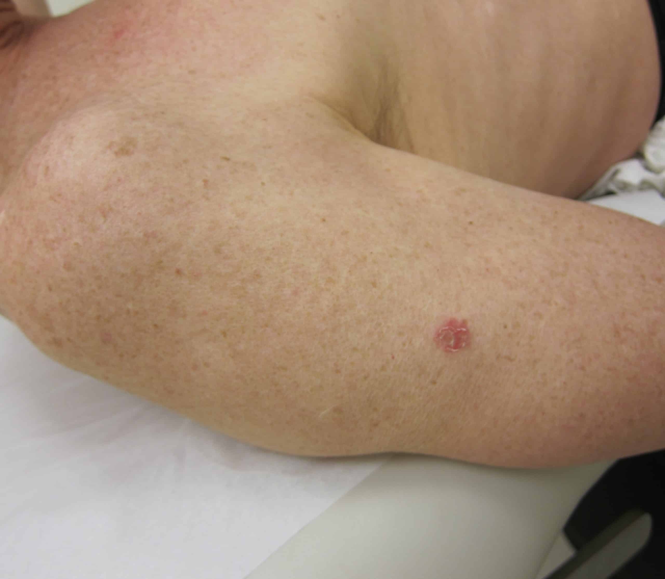 When is Laser Treatment the Best Option for Skin Cancer?
