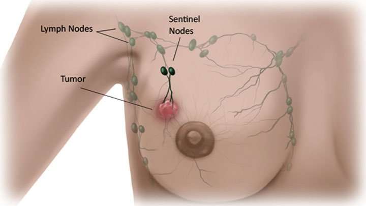 Where and How Does Breast Cancer Spread?