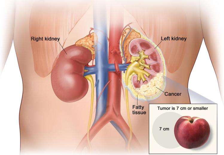 Where Does Kidney Cancer Spread To First