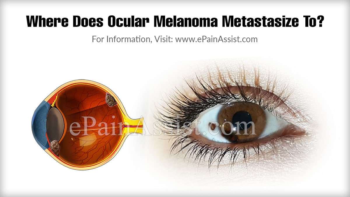Where Does Ocular Melanoma Metastasize To &  How Long Does ...
