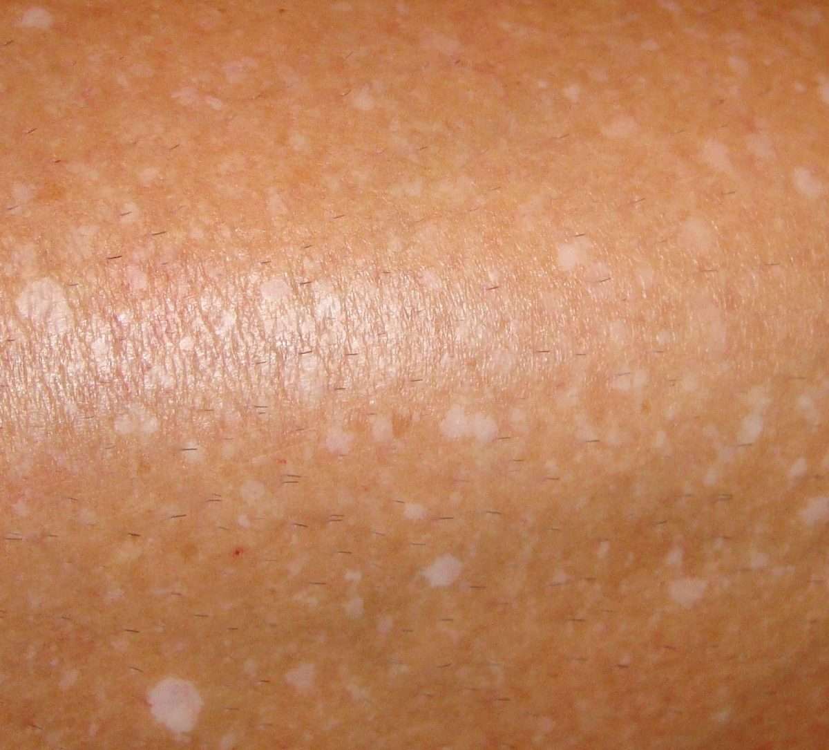 White Dry Spots On Skin