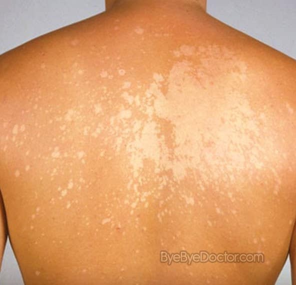 White Spots on Skin  Pictures, Causes and Treatment