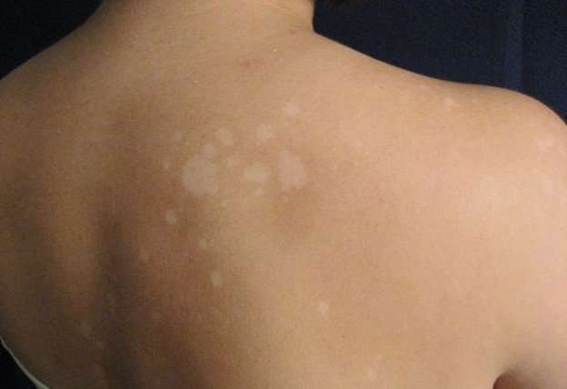 White Spots On The Skin