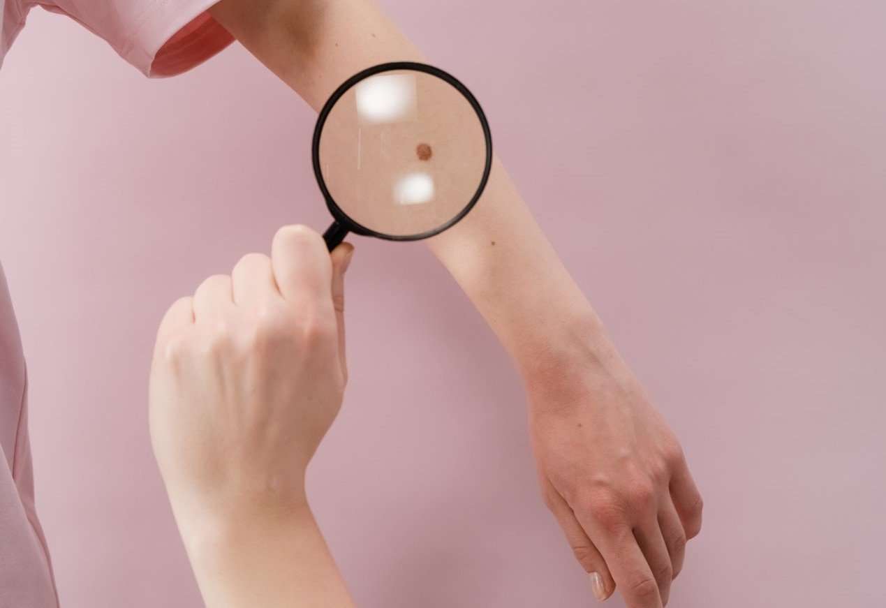 Why Do You Need to Seek Skin Cancer Treatment?
