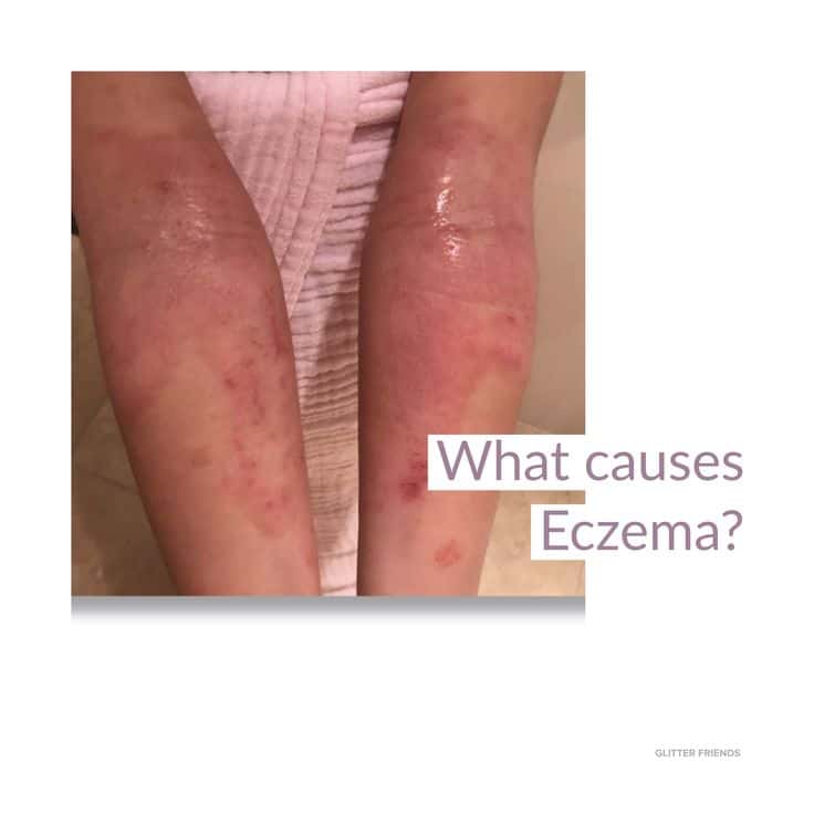 Why some people develop eczema is not well understood. It