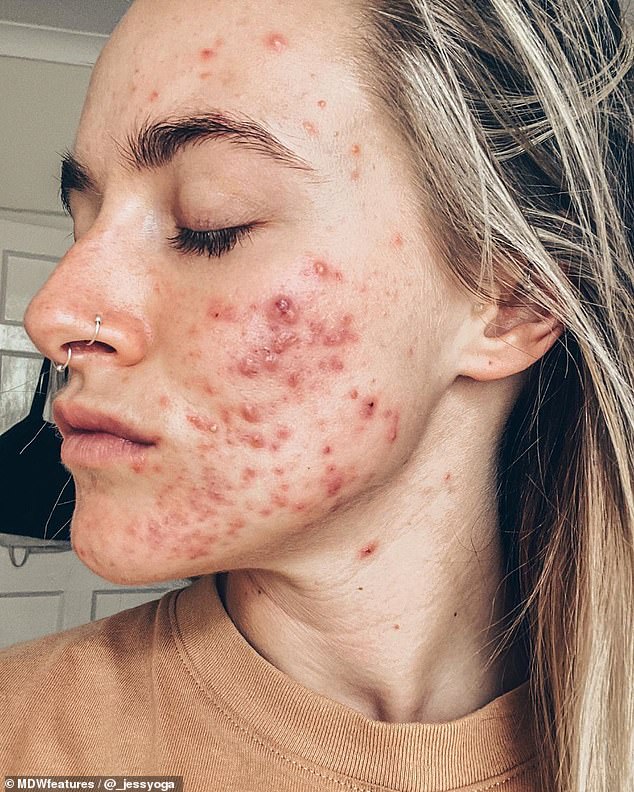 Woman, 25, with painful red acne on her cheeks was told by trolls her ...