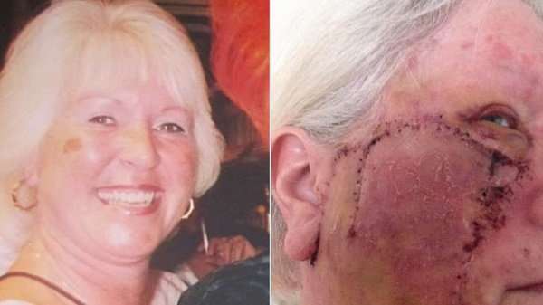 Woman addicted to tanning left with gaping hole in face ...