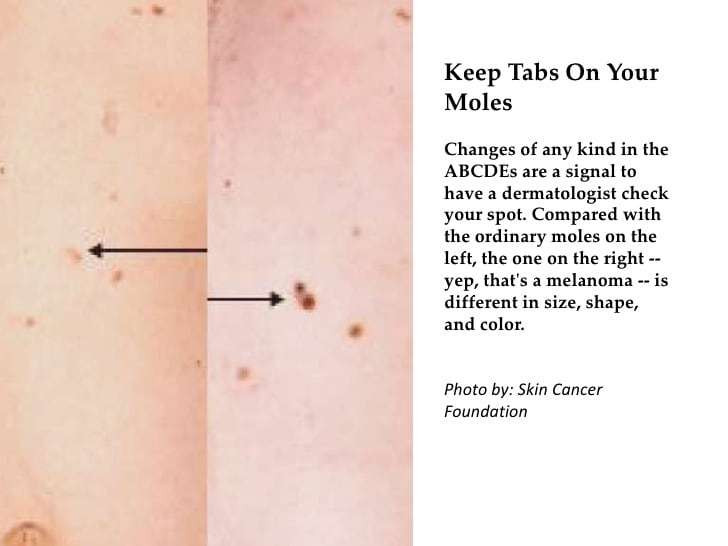 Would You Know Skin Cancer If You Saw It