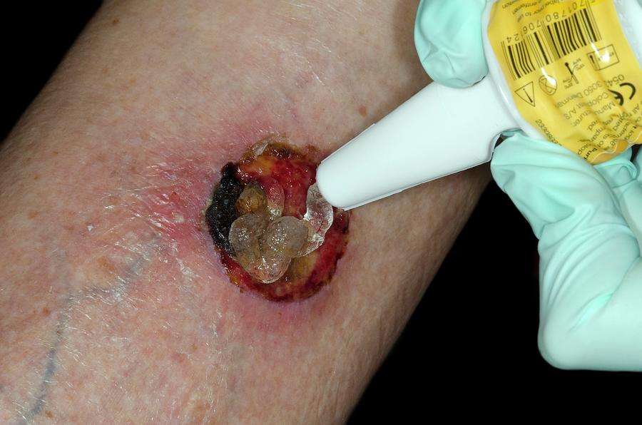 Wound After Skin Cancer Removal Photograph by Dr P ...