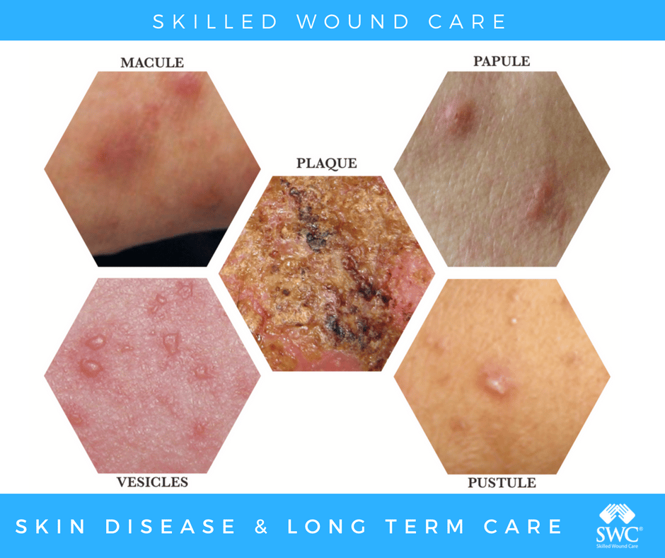 Wound Care Insights: Skin diseases and long